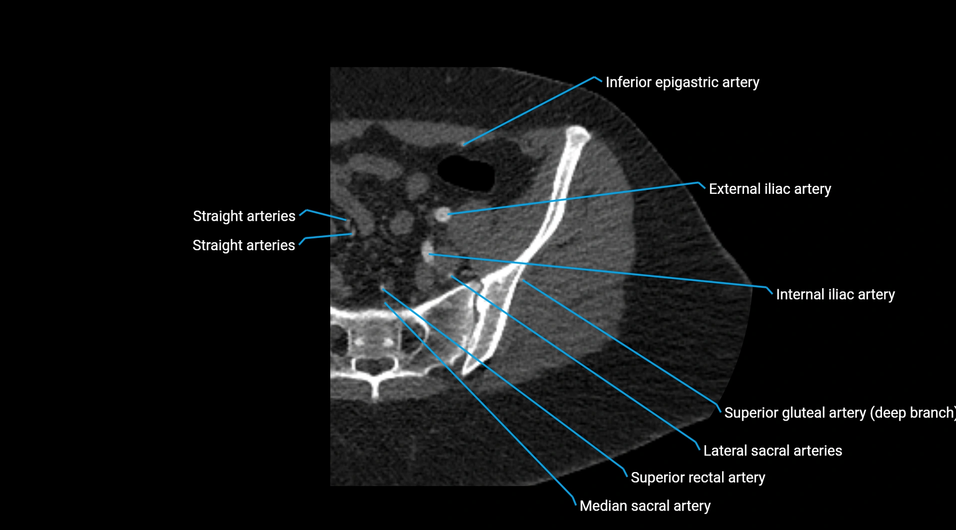 CTA lower limb cross sectional anatomy labelled image _26.webp